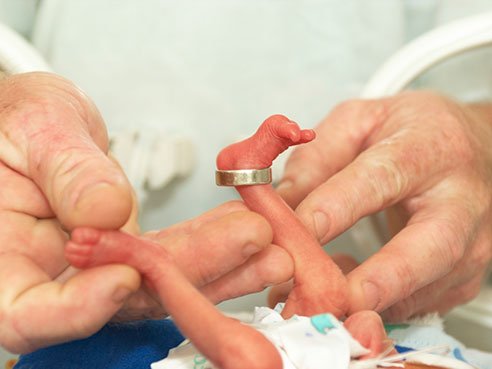 Prematurity, low birth weight significantly impact mortality rates