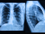Metformin reverses established lung fibrosis