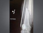 Getting back in the race after in-marathon femur fracture