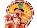 At UAB, the company IN8bio Inc. is running a Phase I clinical trial to treat glioblastoma multiforme, the most aggressive type of cancer that originates in the brain.