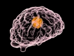 Enzyme inhibitor combined with chemotherapy delays glioblastoma growth
