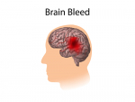 UAB joins study to slow bleeding in the brain