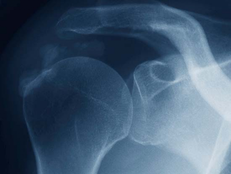 UAB Orthopaedics offers new treatment option for rotator cuff injury