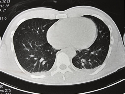 Medicare to cover lung cancer screening with CT scan