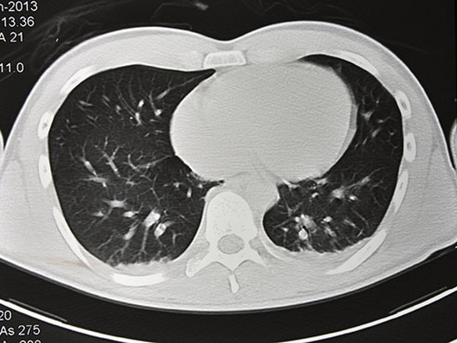 how can you tell if you have lung cancer caused by asbestos