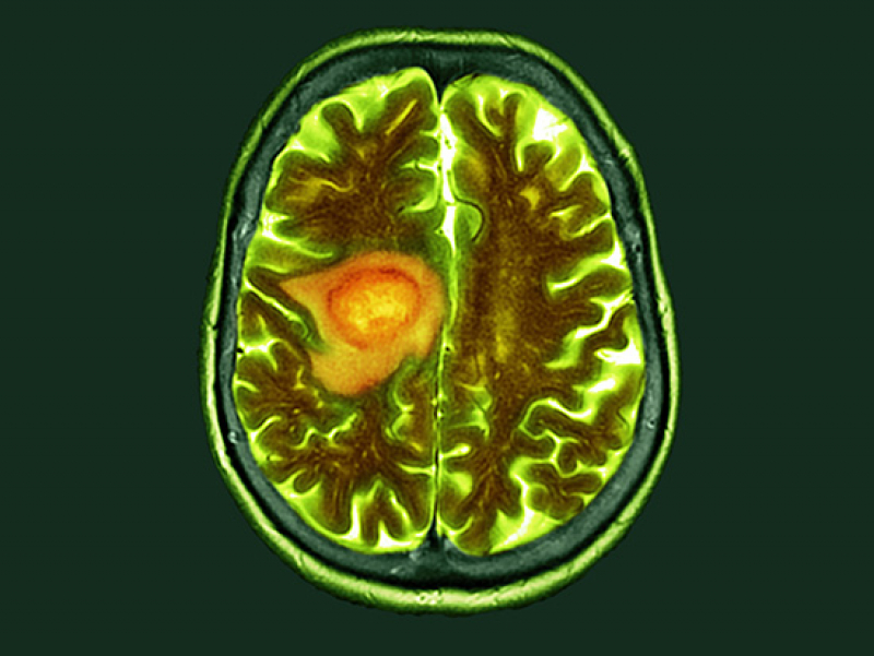 UAB researchers identify potential therapeutic target against malignant brain tumors