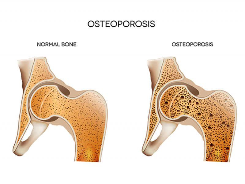 Osteoporosis: UAB-led study approved for a $13.9 million award to investigate prevention of bone fractures