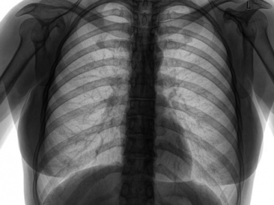 Long-term oxygen treatment does not benefit some COPD patients