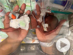 UAB Hospital delivers record-breaking premature baby