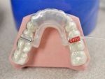 New braces clinical trial sheds metal brackets