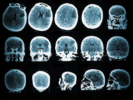Study using i2b2 could help standardize use of therapeutic comas for epileptic patients