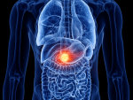 Know the symptoms: Pancreatic cancer
