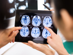 Genes may predict cancer patients at highest risk of chemo brain after BMT