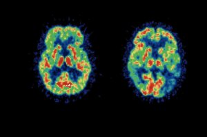 Protein interaction might disrupt neural network in Alzheimer’s