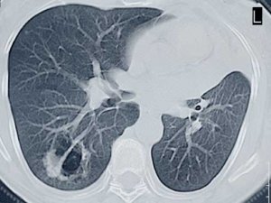 UAB is leader in using newly recommended CT scans for lung cancer detection