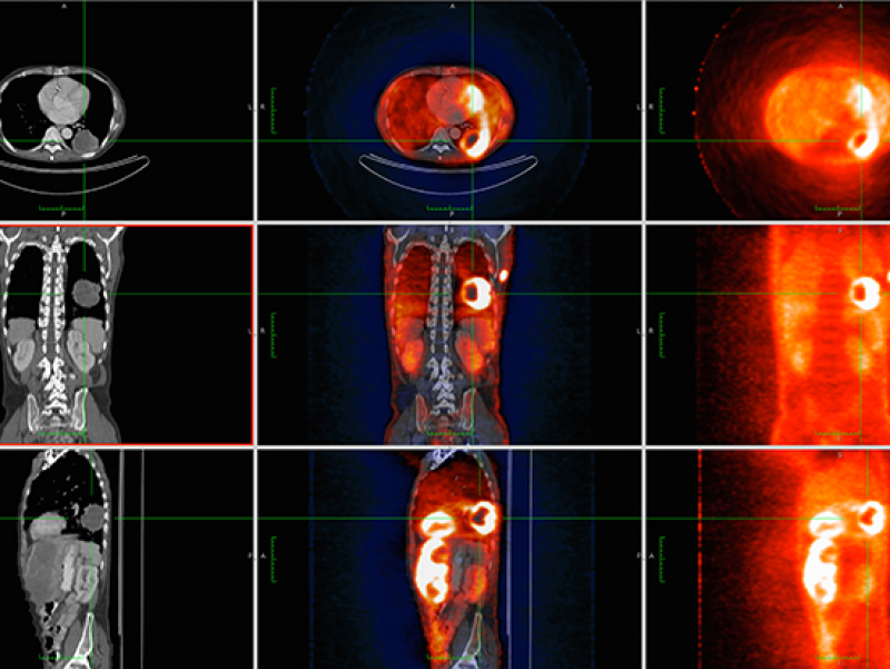 Drug-delivery microcapsules tagged with zirconium-89 can be tracked by PET imaging