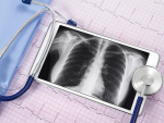 Pilot telemedicine program to serve lung nodule patients in Bibb County