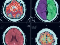 Head injuries often impair medical decision-making skills