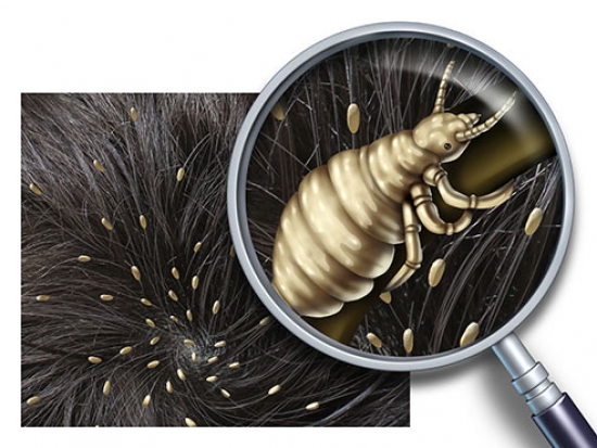 Don't let head lice get the best of your family this school year - News |  UAB