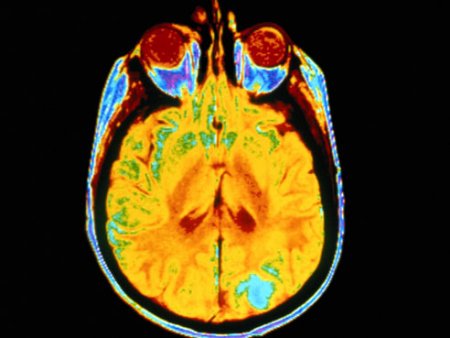 Researchers discover gene deletion associated with brain cancer