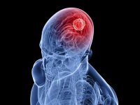UAB scientists find link between seizures and brain tumors