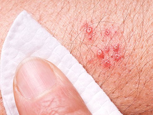 Use of biologic therapies for inflammatory diseases does not appear to increase risk of shingles