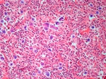 Child survivors of Hodgkin lymphoma have increased risk of second cancer