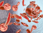 Novel sickle cell medication to help reduce pain crises, related hospitalizations