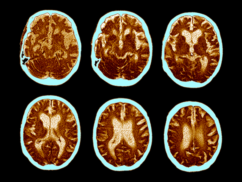 UAB joins international study of promising Alzheimer’s disease treatment