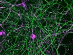 Discovery may lead to a treatment to slow Parkinson’s disease