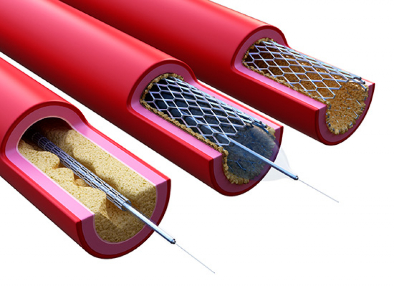 Heart disease: NIH grant to UAB will fund study of safer, more durable stents