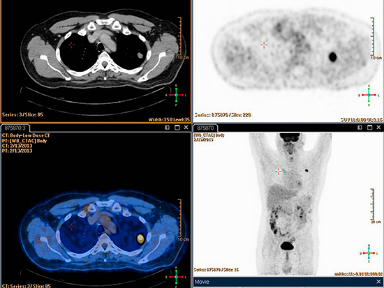 Hypoxia imaging and combination therapy aid immunotherapy treatment of solid tumors