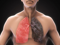 New CT scan analysis predicts respiratory illness and death in COPD