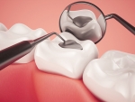 UAB dentist develops new filling for root canal treatments