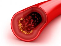 Study shows U.S. adults have not improved when it comes to cholesterol
