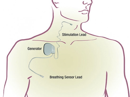New implantable device available at UAB eases sleep apnea