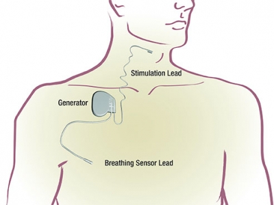 New implantable device available at UAB eases sleep apnea