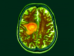 Research reveals potential targets for therapeutic development for glioblastoma
