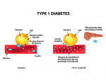 Type 1 diabetes: B cell-derived natural antibodies suppress autoimmune pathogenesis