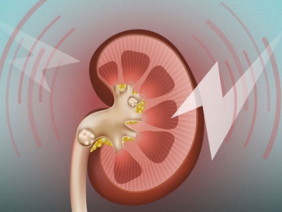 Kidney stones - a marker of overall kidney health