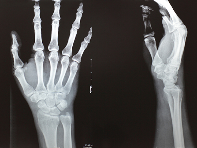 DREAM Challenge to automate assessment of radiographic damage from rheumatoid arthritis
