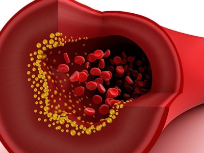 Study of blood-thinners to advance personalized medicine