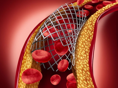Simple genetic test shows promise for better outcomes in heart stent patients