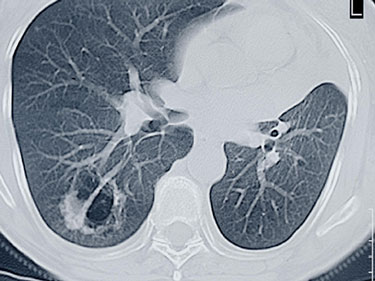 dransfield-CT-lung-cancer s